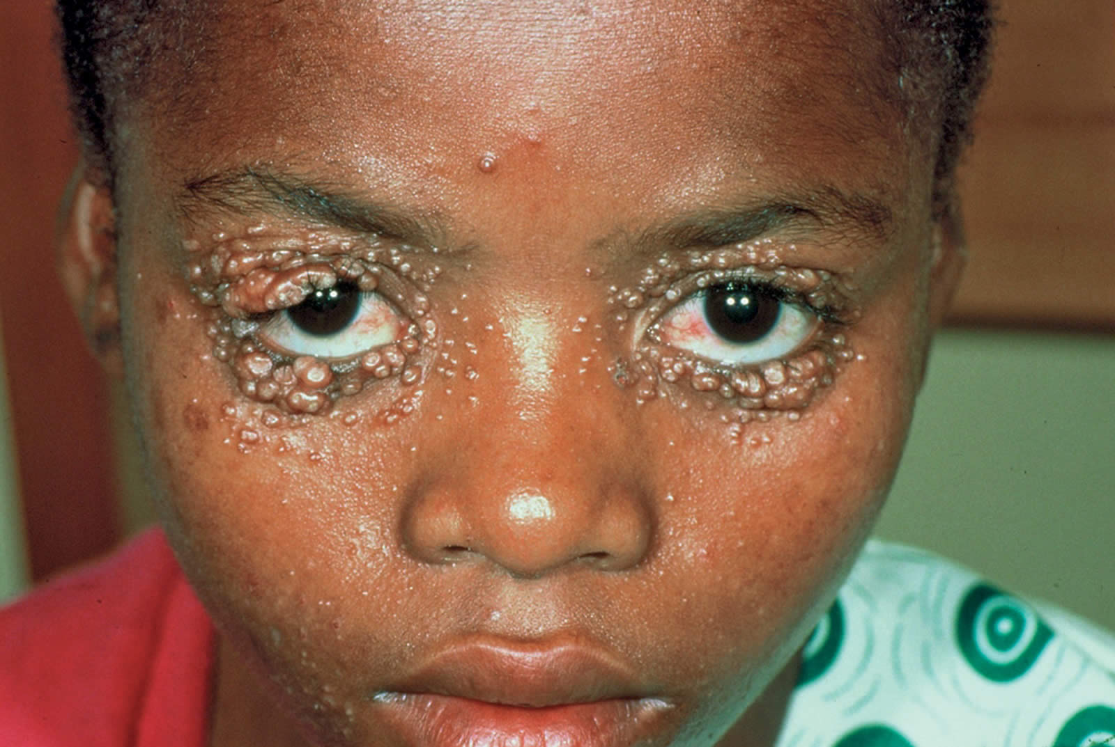 Community Eye Health Journal » Conjunctivitis