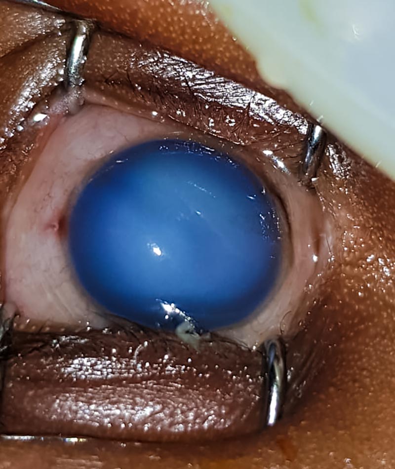Close up image of damaged eye with hazy cornea