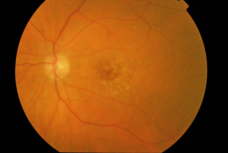 Early AMD. Image credit: David Yorston