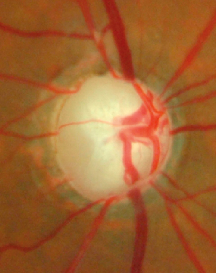 Close up image of an optic disc