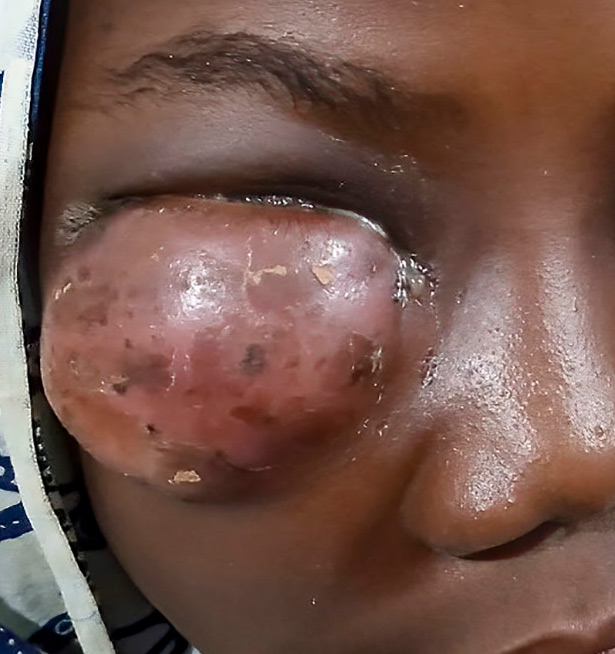 A swollen eyelid
