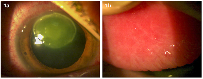 Two images. Image 1a is a close up images of the front of the eye, stained with fluoroscein and the second is a close up image iof the underside of an eyelid